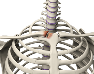 Sternoclavicular Joint Arthritis Seattle, WA | Shoulder Instability ...