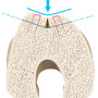 Trochleaplasty