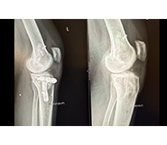 Anterior Tibial Osteotomy