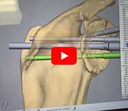 Custom Solutions for Complex Total Shoulder Replacements