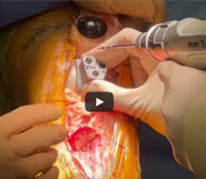 Dr. Garcia demonstrates a custom patellofemoral replacement