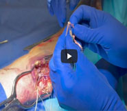 Dr. Garcia’s new technique for elbow UCL reconstruction