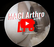 Dr. Garcia performs Challenging Cartilage Repair with MACI® Treatment