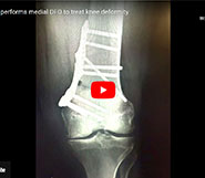 Dr. Garcia performs medial DFO to treat knee deformity