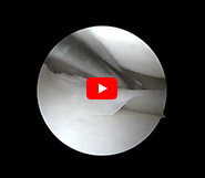 Meniscal Repair Using Fiberstitches 2025