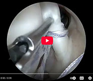 New Biceps Tenodesis with 360 labral repair