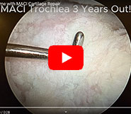 Remarkable Outcome with MACI Cartilage Repair