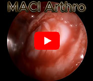 Revolutionizing Cartilage Surgery with MACI®